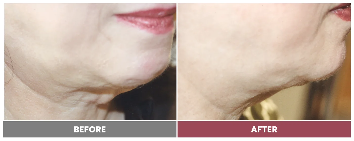 PDO THREAD LIFT FOR SKIN TIGHTENING - Case 3