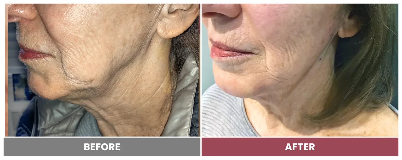 PDO THREAD LIFT FOR SKIN TIGHTENING - Case 4