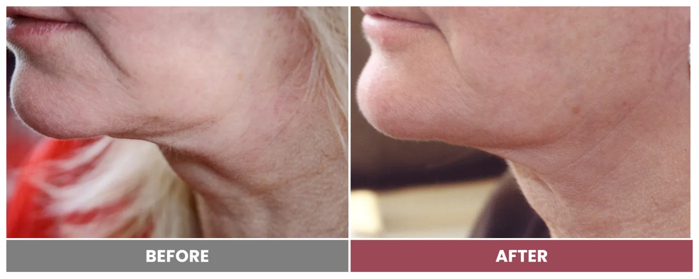 PDO THREAD LIFT FOR SKIN TIGHTENING - Case 5