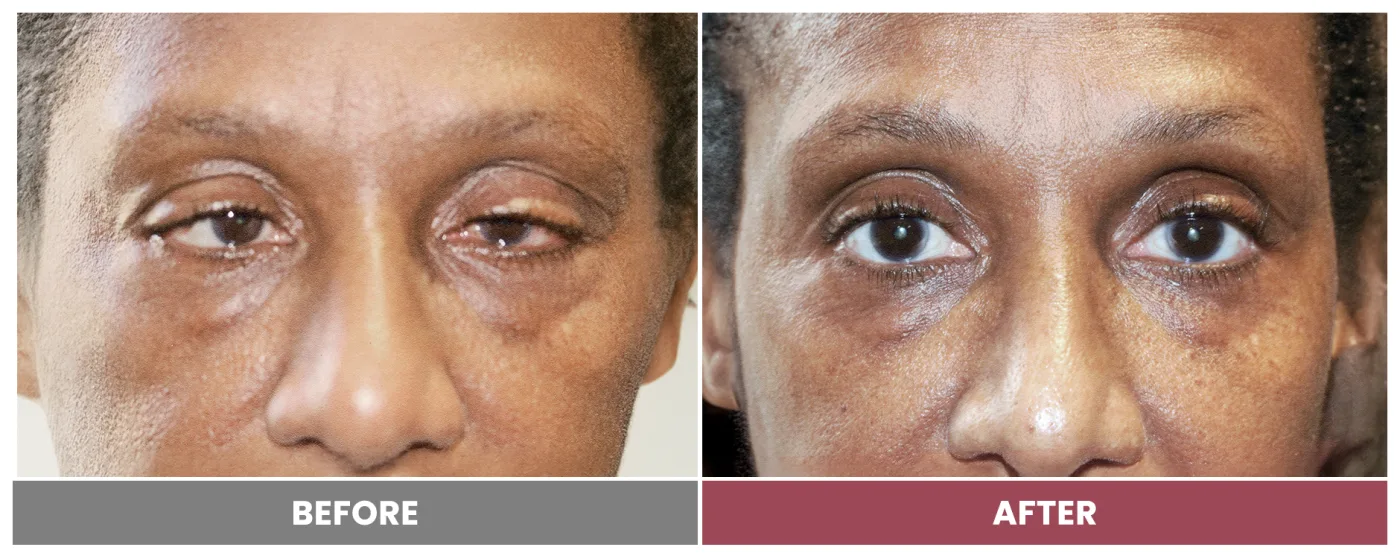 PTOSIS REPAIR - Case 1