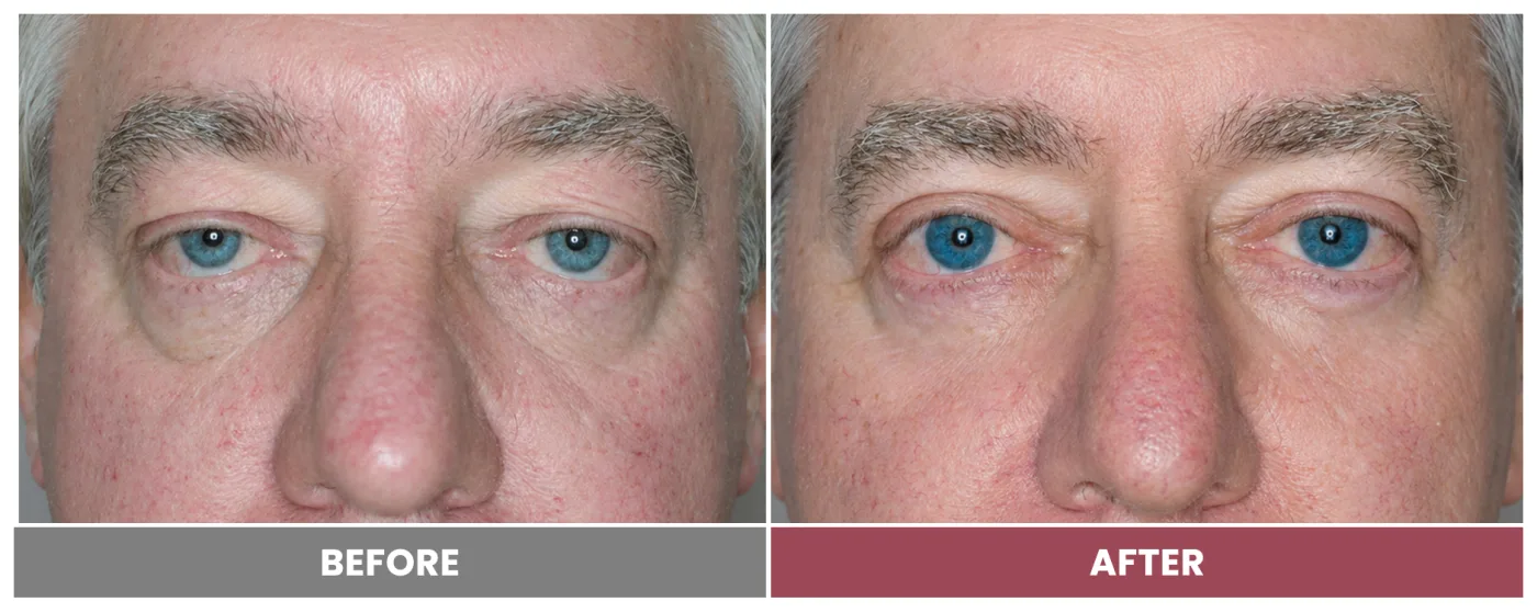 PTOSIS REPAIR - Case 12