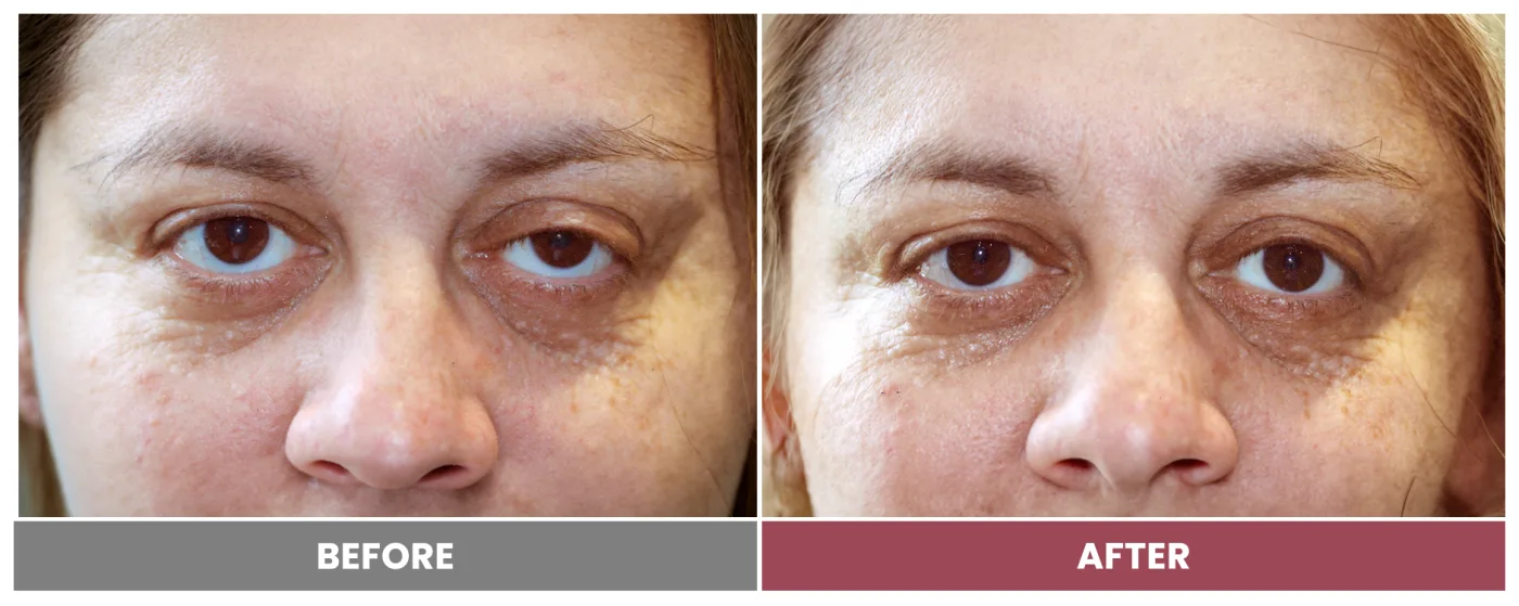 PTOSIS REPAIR - Case 14