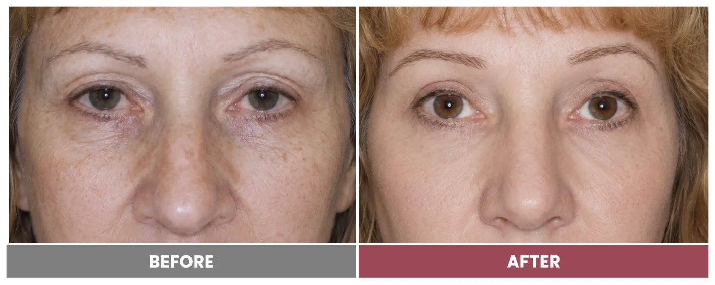 PTOSIS REPAIR - Case 16