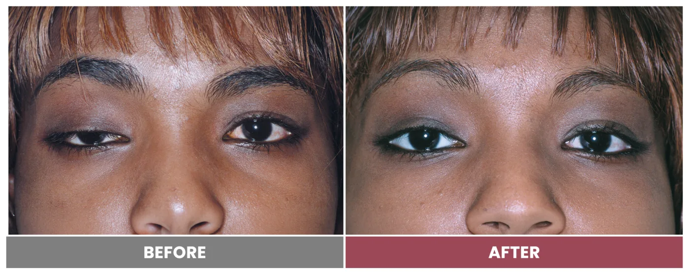 PTOSIS REPAIR - Case 17