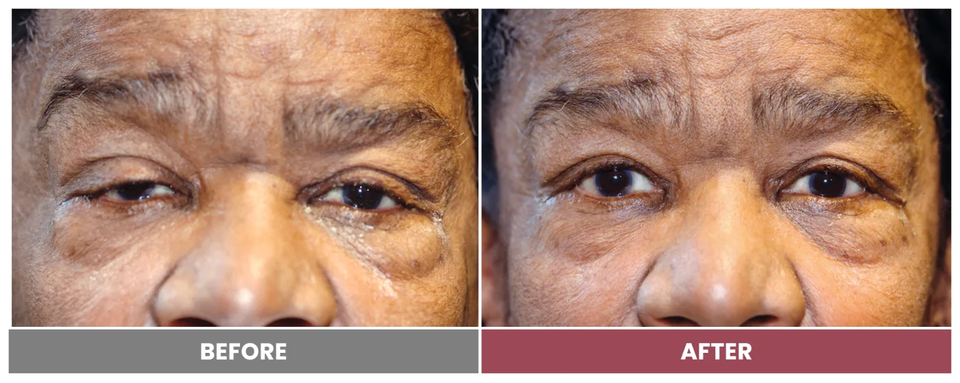 PTOSIS REPAIR - Case 19