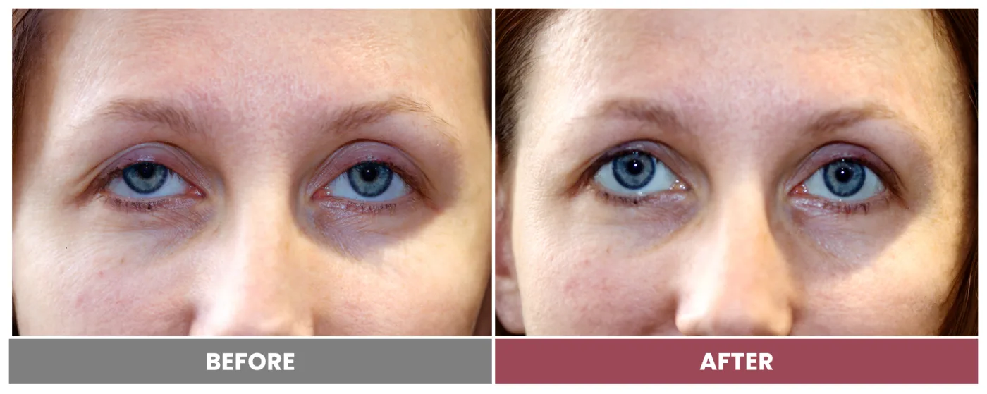 PTOSIS REPAIR - Case 20