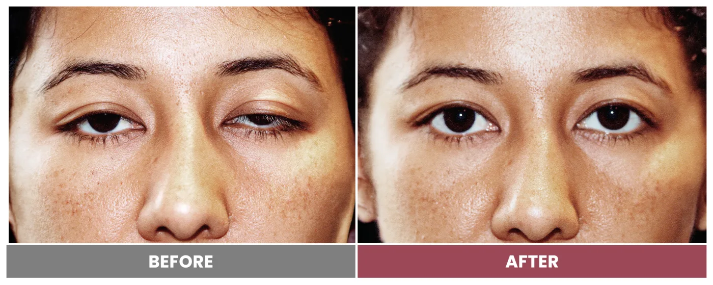 PTOSIS REPAIR - Case 21
