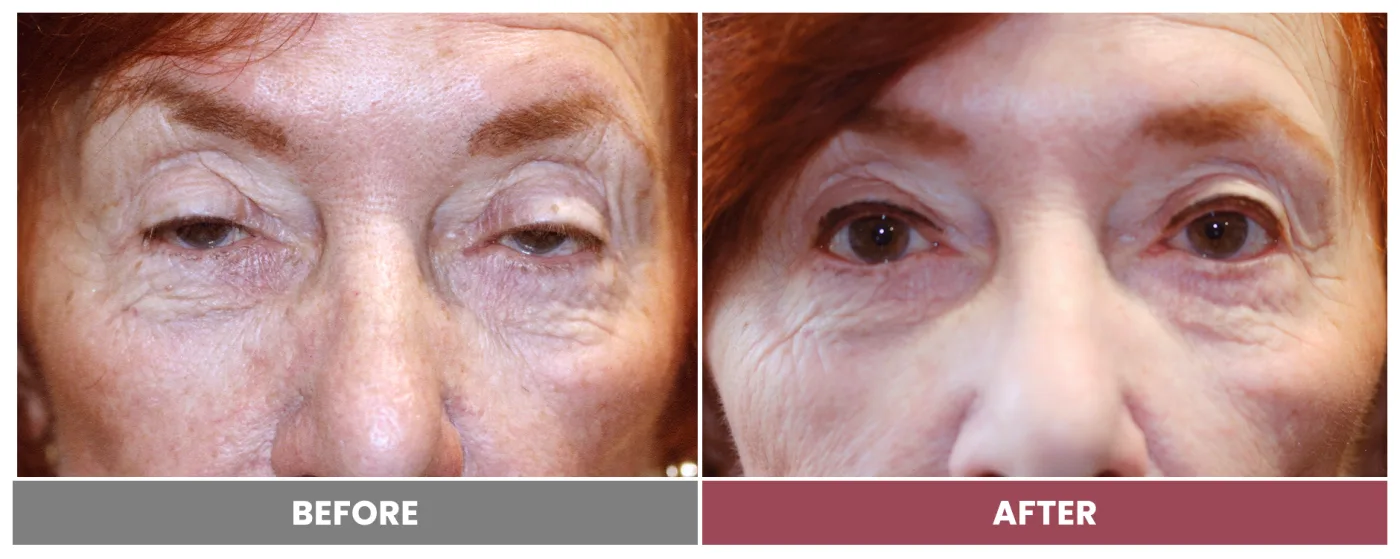 PTOSIS REPAIR - Case 23