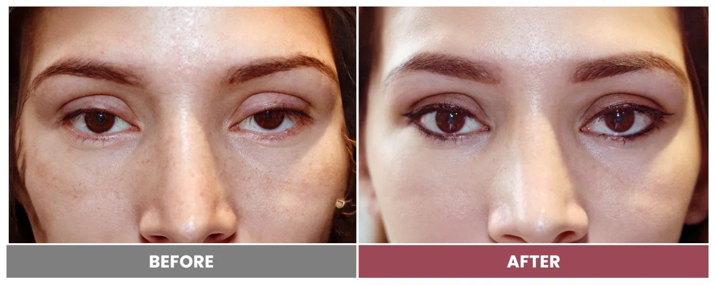 PTOSIS REPAIR - Case 25