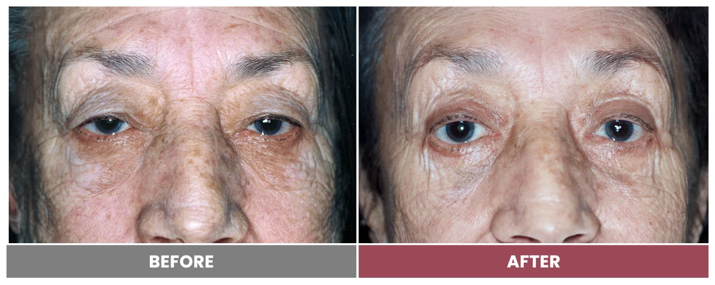 PTOSIS REPAIR - Case 26