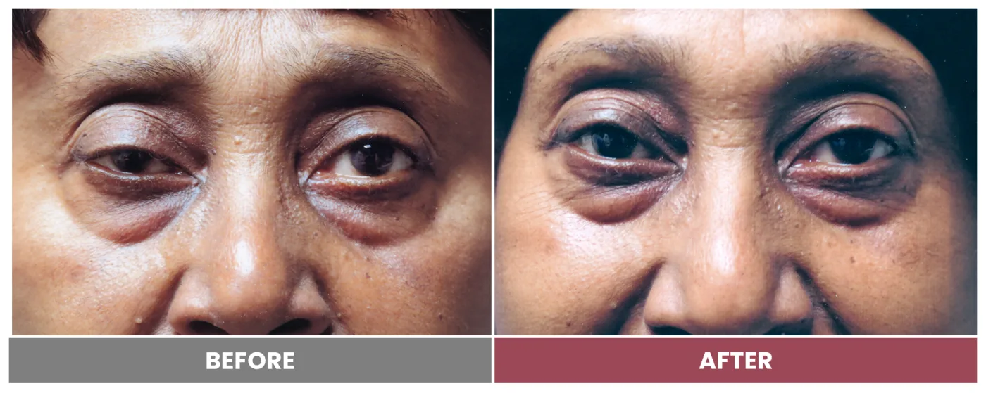 PTOSIS REPAIR - Case 28