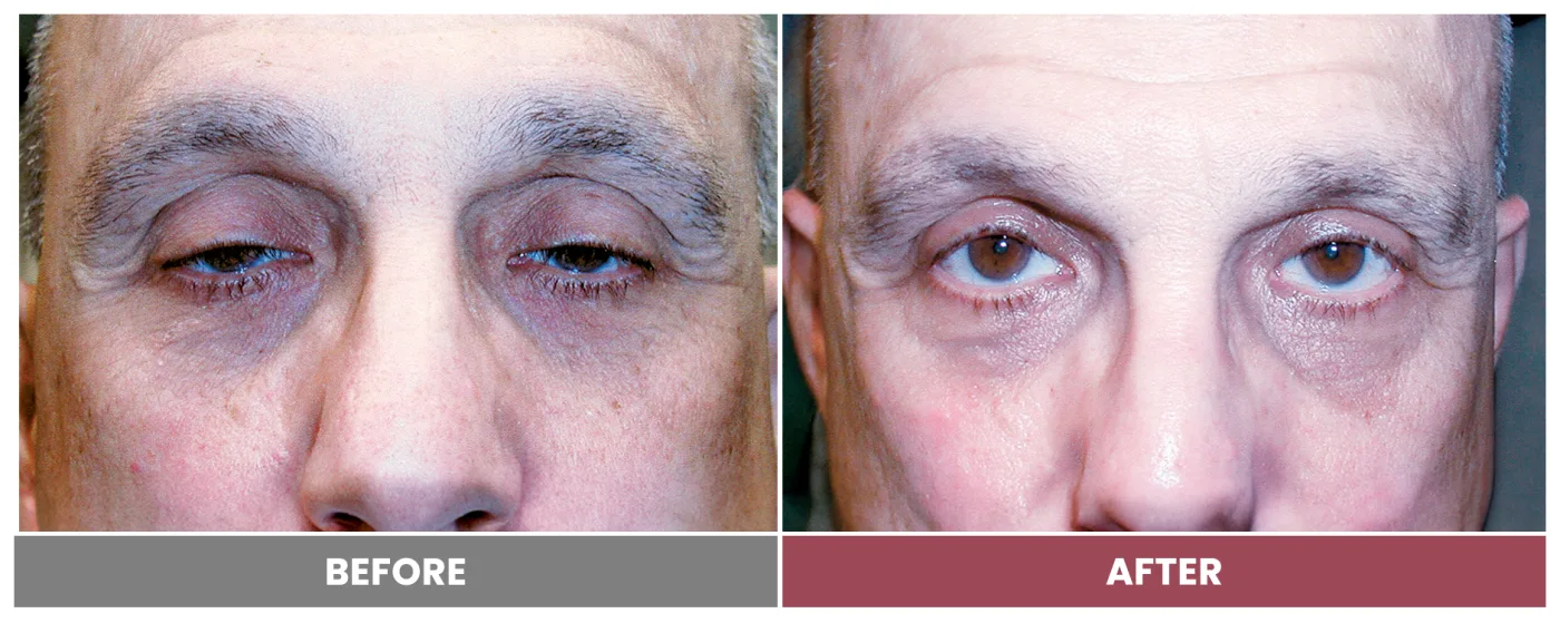 PTOSIS REPAIR - Case 3