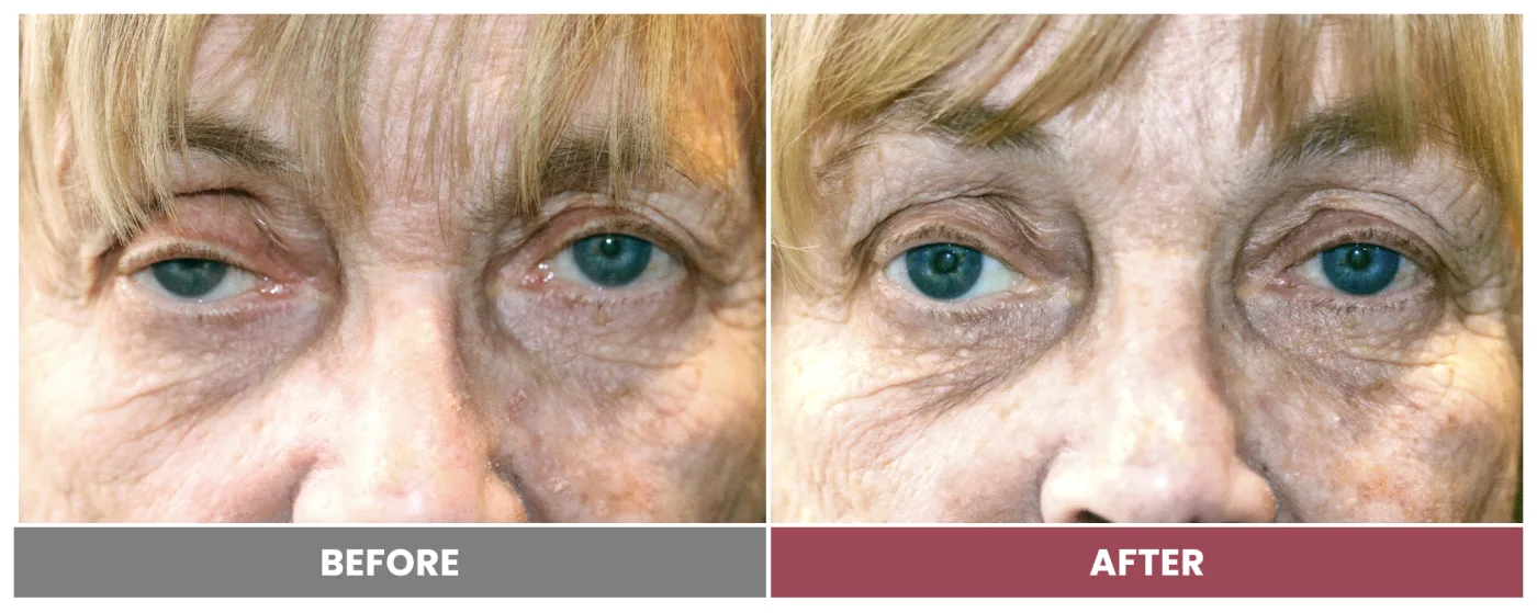 PTOSIS REPAIR - Case 30