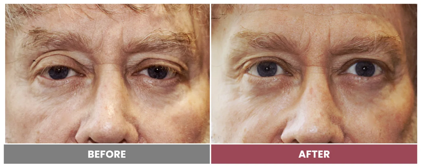 PTOSIS REPAIR - Case 34
