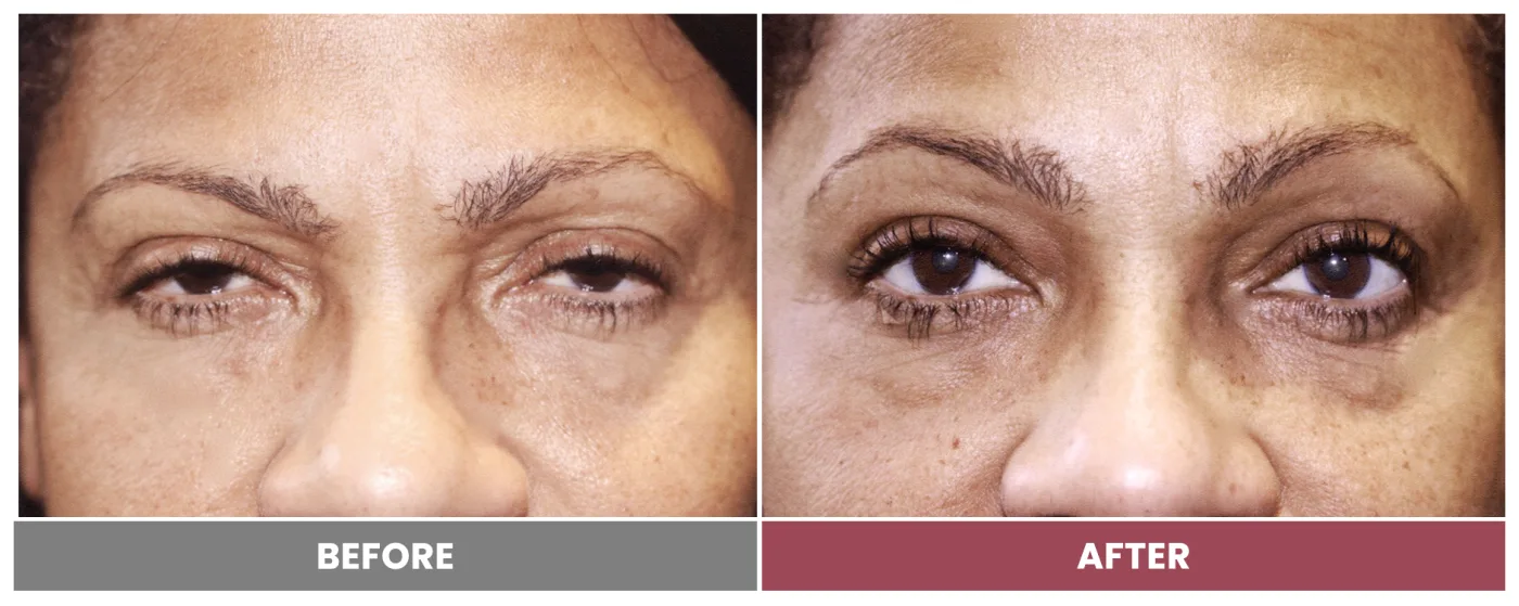 PTOSIS REPAIR - Case 35