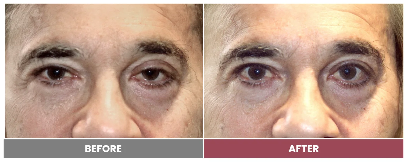PTOSIS REPAIR - Case 38