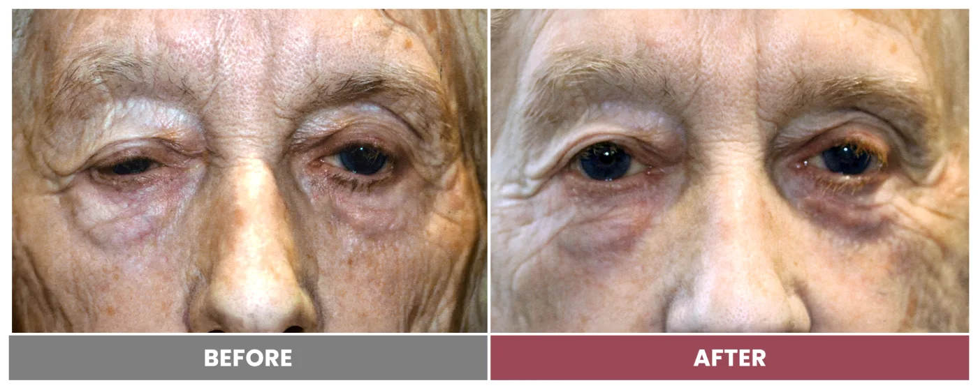 PTOSIS REPAIR - Case 39