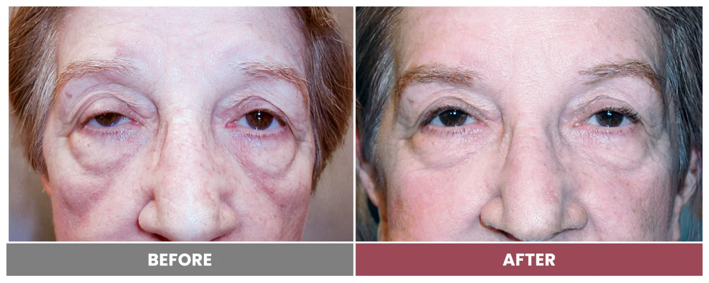 PTOSIS REPAIR - Case 4