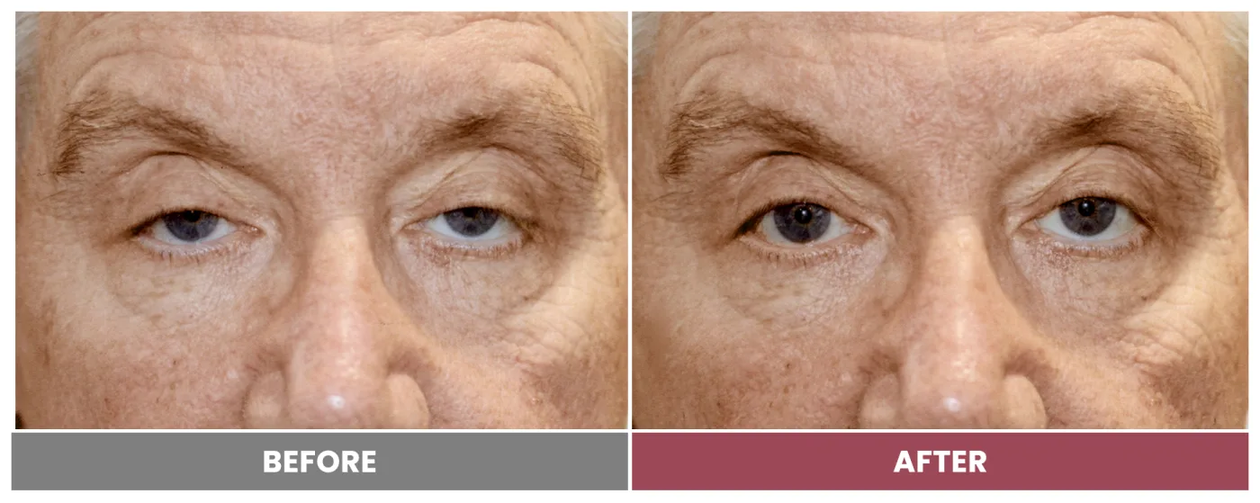 PTOSIS REPAIR - Case 40