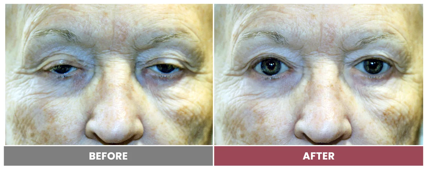 PTOSIS REPAIR - Case 41