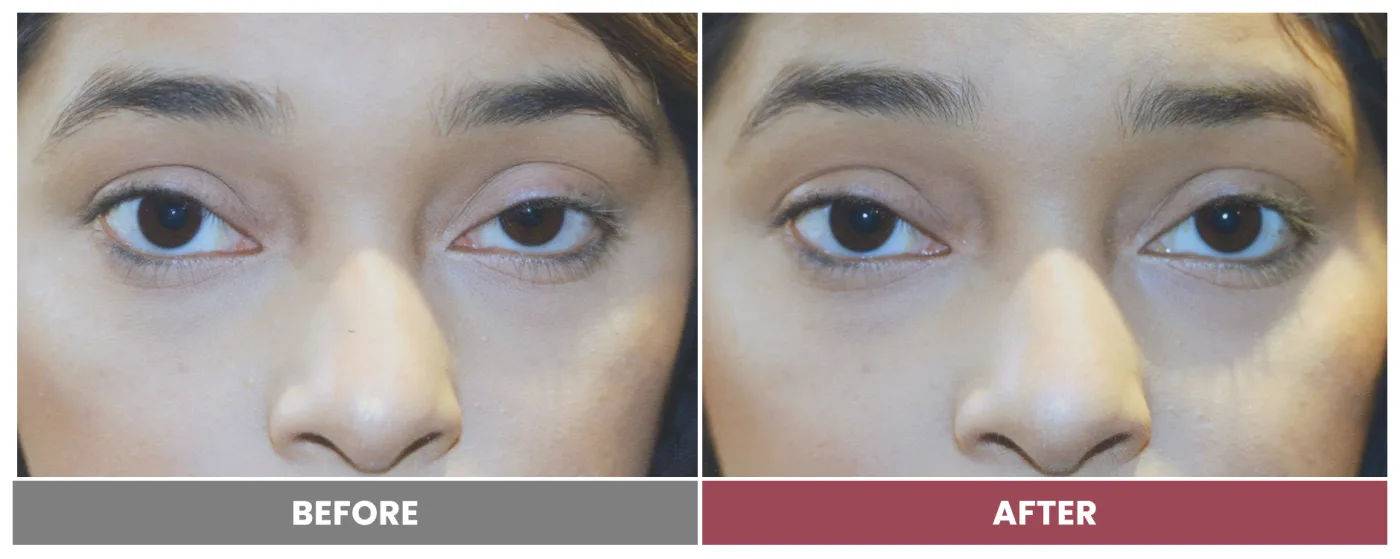 PTOSIS REPAIR - Case 42