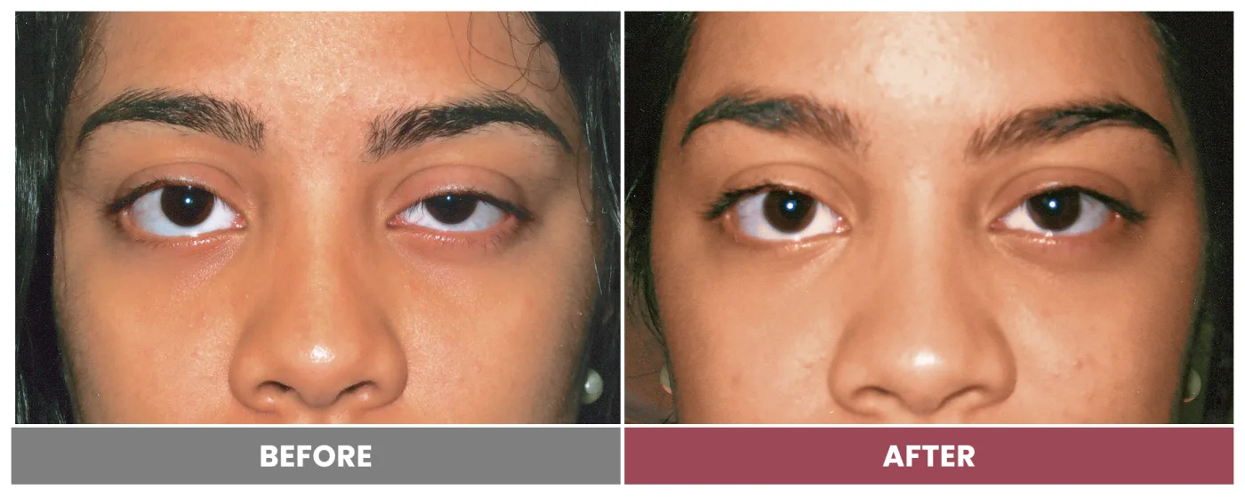 PTOSIS REPAIR - Case 46