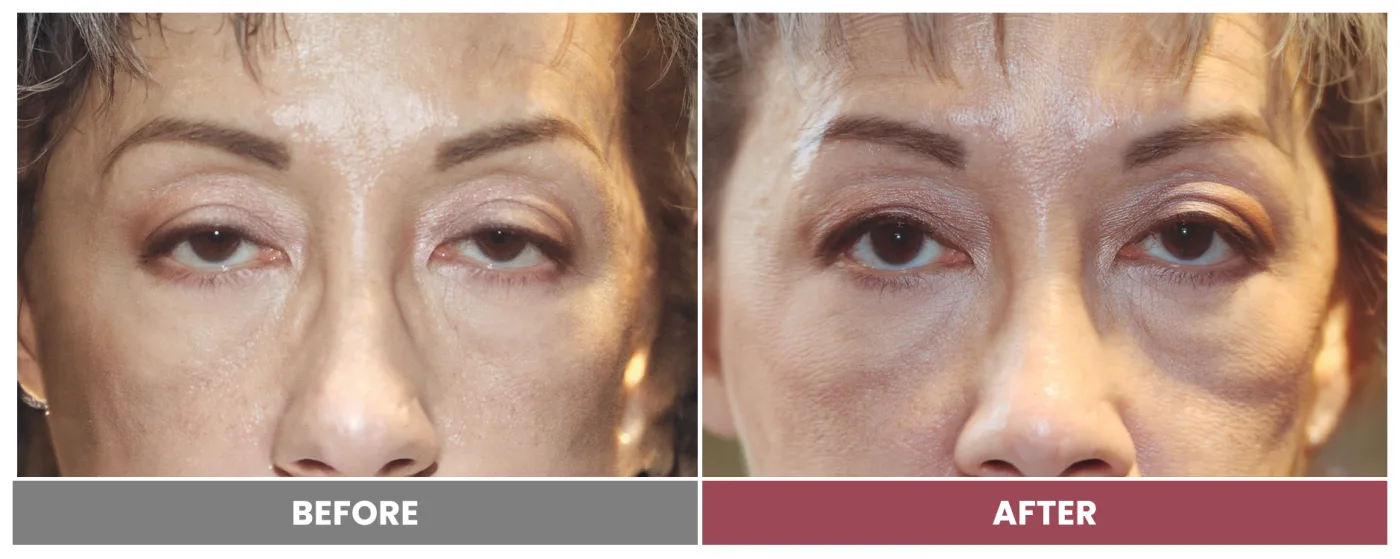 PTOSIS REPAIR - Case 47