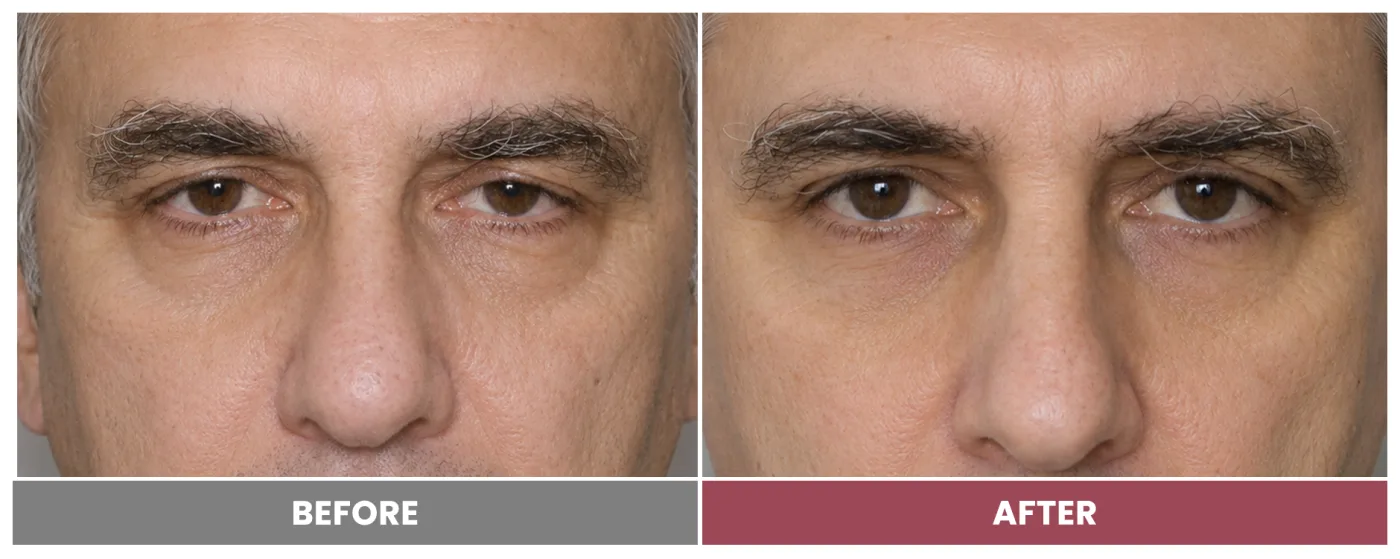 PTOSIS REPAIR - Case 48