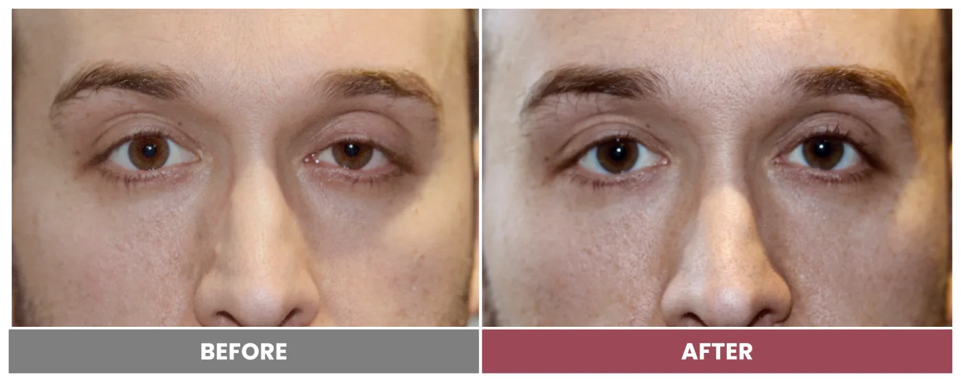 PTOSIS REPAIR - Case 49