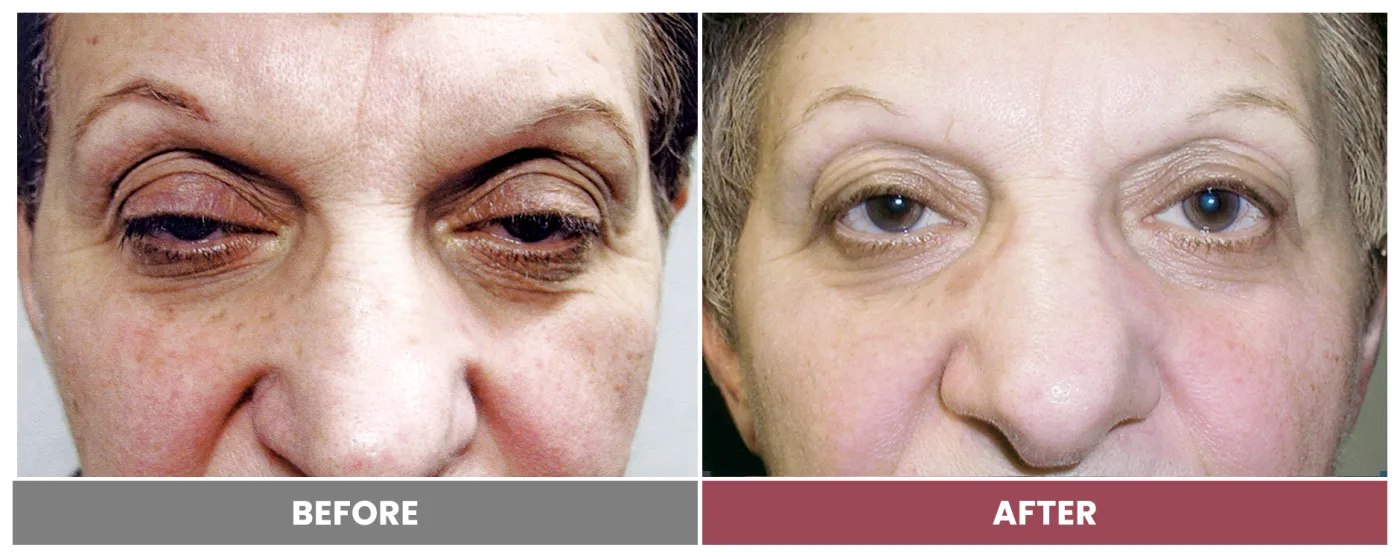 PTOSIS REPAIR - Case 5