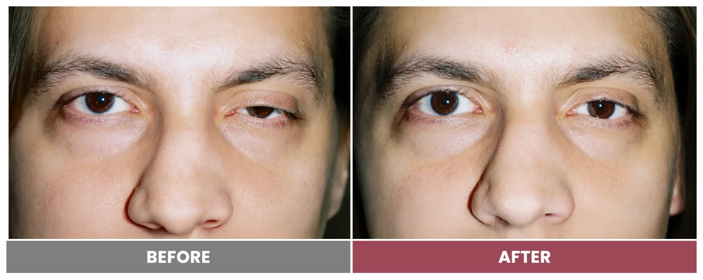 PTOSIS REPAIR - Case 56