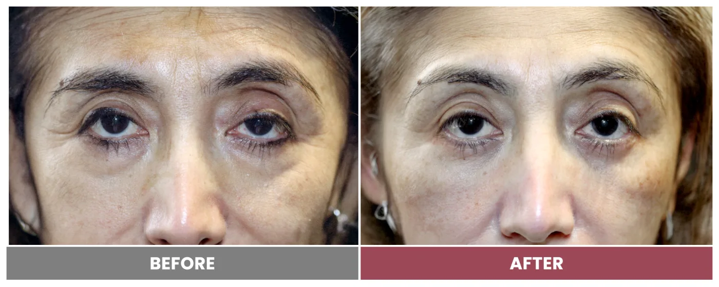 PTOSIS REPAIR - Case 57