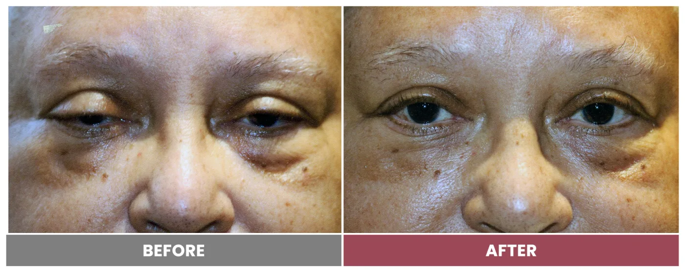 PTOSIS REPAIR - Case 63