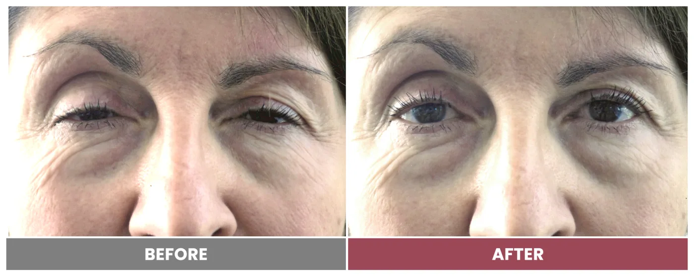 PTOSIS REPAIR - Case 66