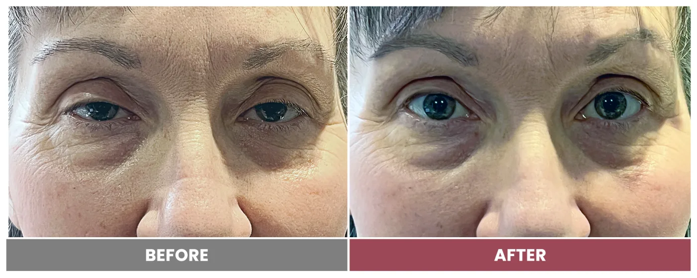 PTOSIS REPAIR - Case 69