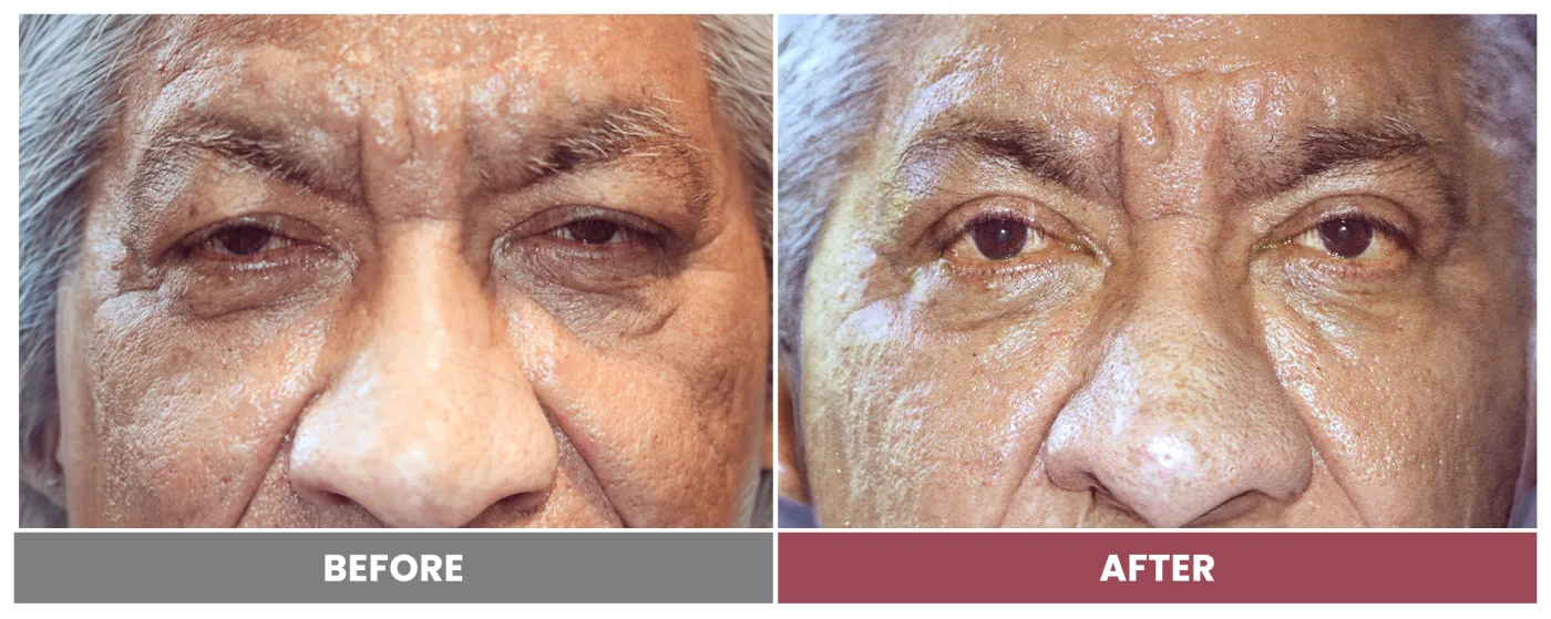 PTOSIS REPAIR - Case 71