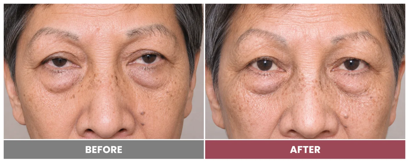 PTOSIS REPAIR - Case 73