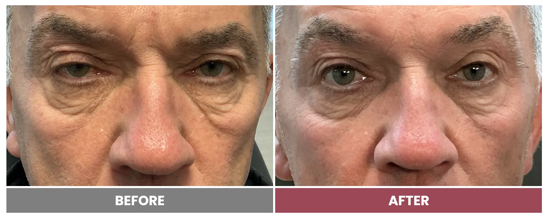 PTOSIS REPAIR - Case 74