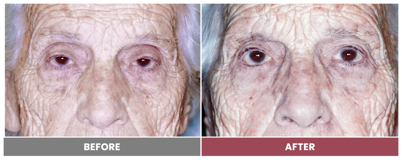 PTOSIS REPAIR - Case 8