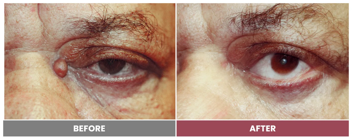 TUMOR REMOVAL AND RECONSTRUCTION - Case 14