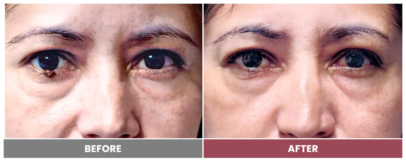 TUMOR REMOVAL AND RECONSTRUCTION - Case 15