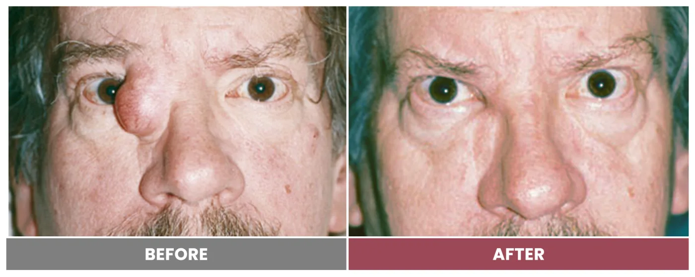 TUMOR REMOVAL AND RECONSTRUCTION - Case 3