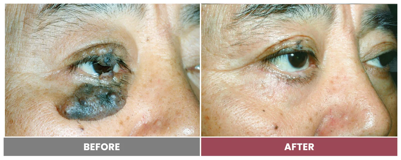 TUMOR REMOVAL AND RECONSTRUCTION - Case 5