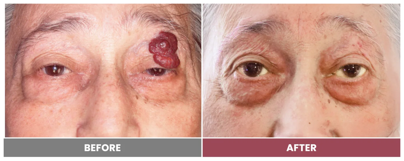 TUMOR REMOVAL AND RECONSTRUCTION - Case 9